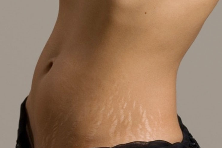 home remedy for stretch marks
