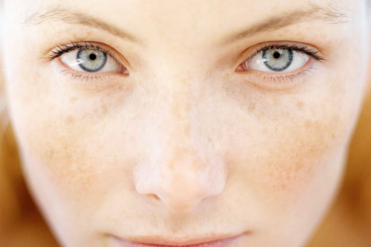 To Treat Pigmentation Marks