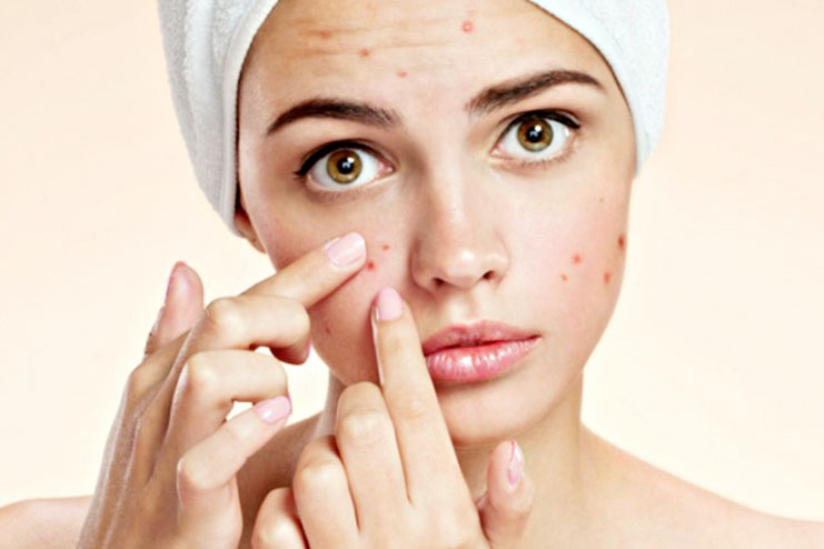 Preventing Acne and Pimples