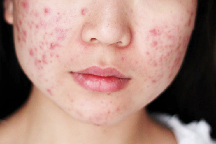 Acne And Eczema