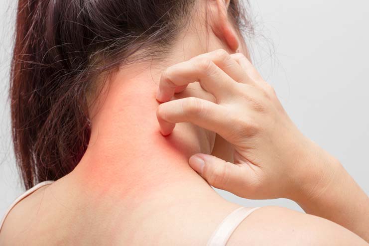 Relieve Pain Itching Due To Bites