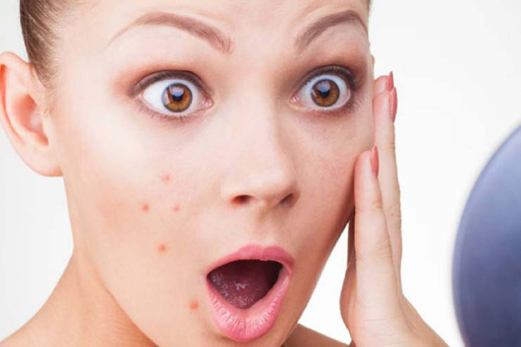 Sandalwood Remedy For Pimples
