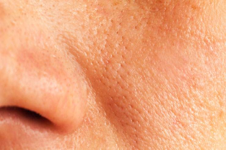 What is enlarged pores