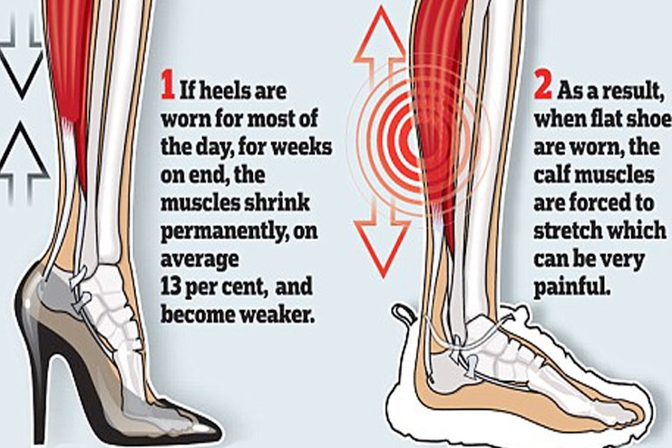 Shortening of achilles tendon