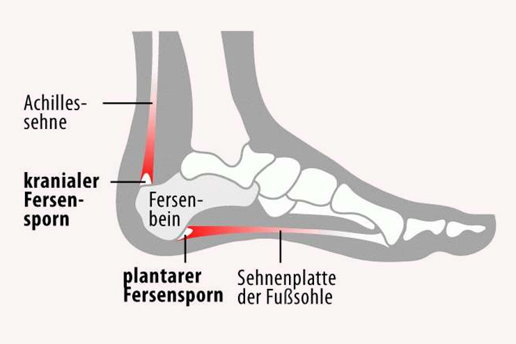 Haglund’s Deformity