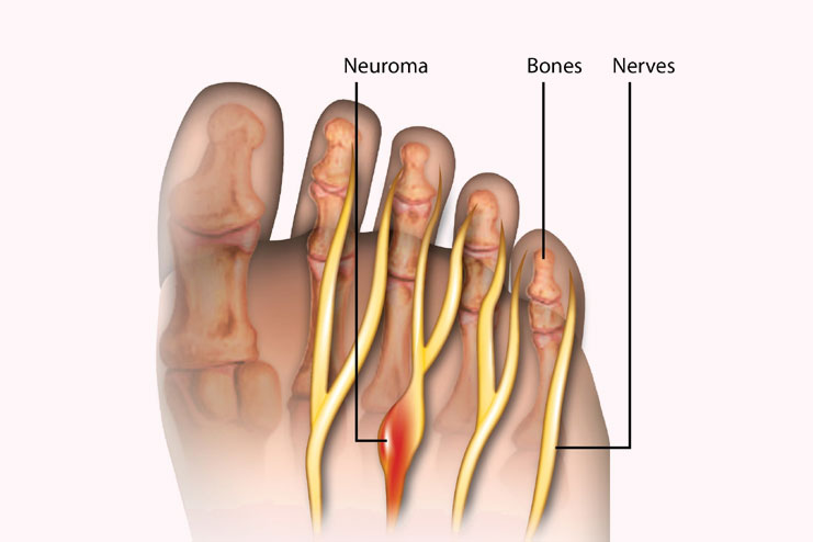 Morton’s Neuroma