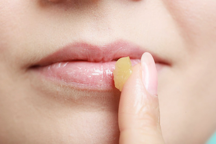 Swollen lips home remedies for Home Remedies