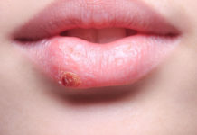 home Remedies to Treat Herpes