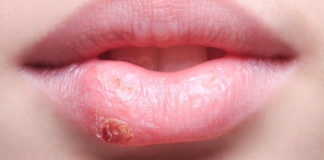 home Remedies to Treat Herpes