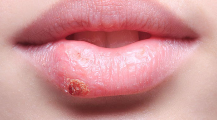 home Remedies to Treat Herpes