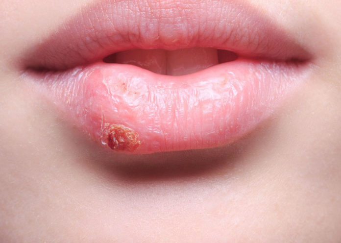 home Remedies to Treat Herpes