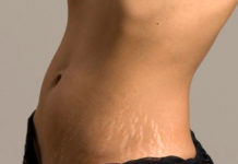 Stretch Marks Reducing Foods