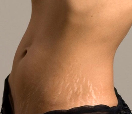 Stretch Marks Reducing Foods