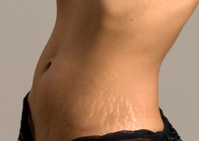 Stretch Marks Reducing Foods