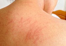 Home Remedies to Heal Skin Rashes