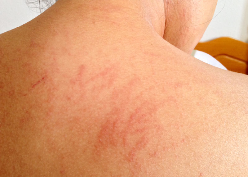 How to Heal Skin Rash from Home