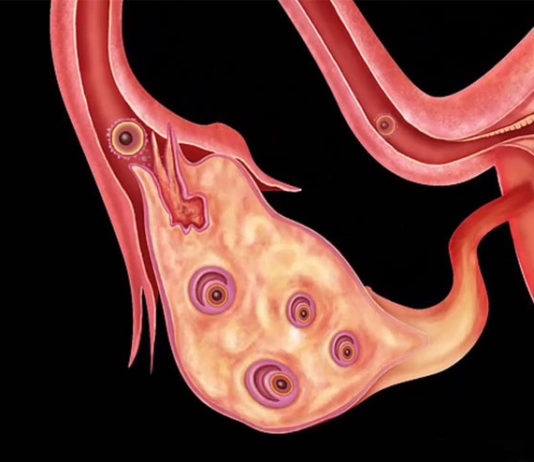 treat Polycystic Ovary Syndrome