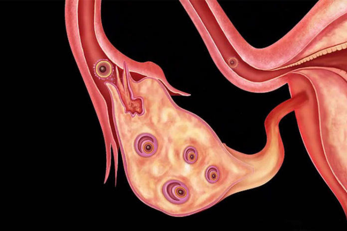 treat Polycystic Ovary Syndrome