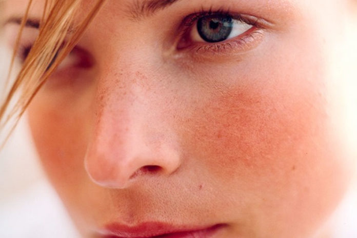 Calm Rosacea