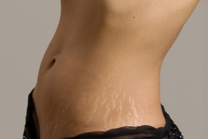 Prevent stretch marks