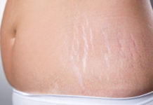 Home Remedies for Stretch Marks