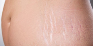 Home Remedies for Stretch Marks