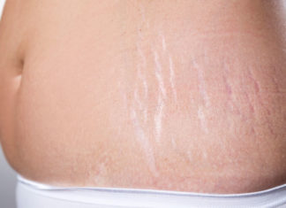 Home Remedies for Stretch Marks