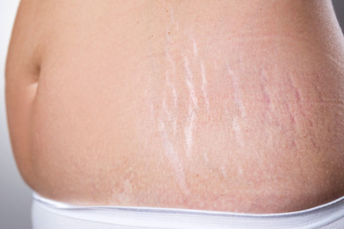 Home Remedies for Stretch Marks