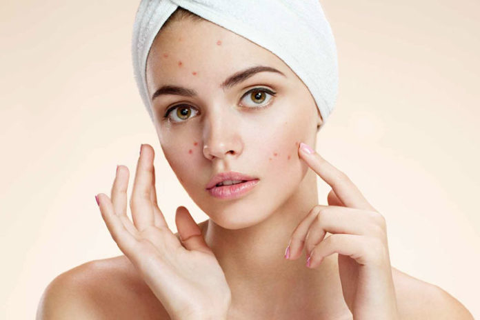 Treatment of Acne