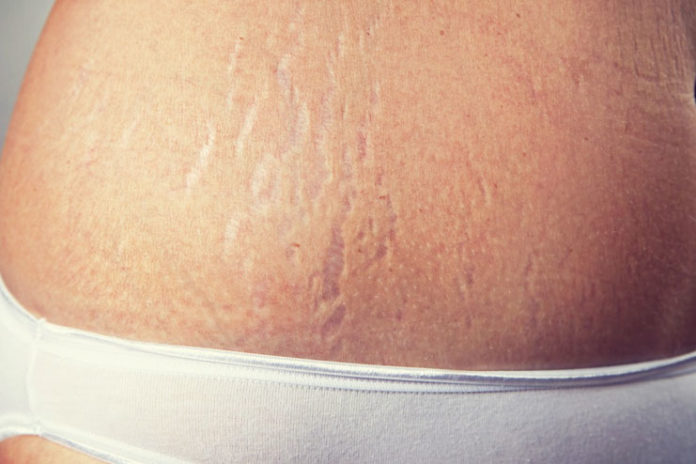 Treatment of Stretch Marks