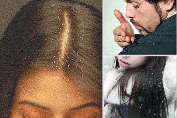 Australian beauty tips to get rid of dandruff