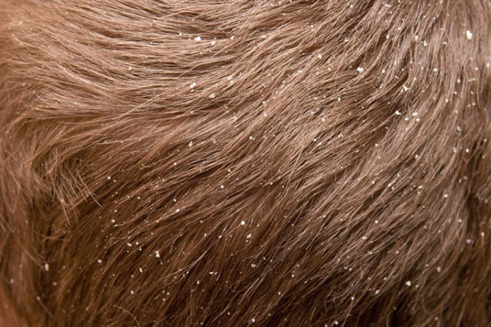 Say Goodbye to Dandruff