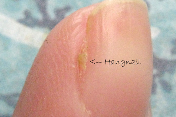 Hangnails