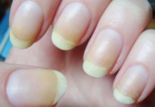 6 Wonderfully Amazing Remedies To Treat Yellow Fingernails