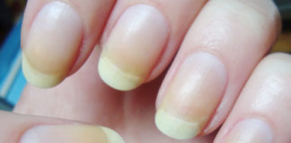 6 Wonderfully Amazing Remedies To Treat Yellow Fingernails