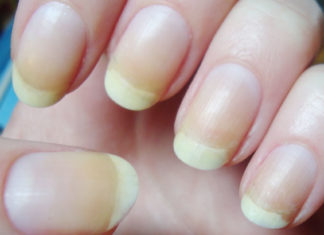 6 Wonderfully Amazing Remedies To Treat Yellow Fingernails
