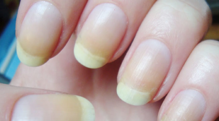 6 Wonderfully Amazing Remedies To Treat Yellow Fingernails