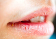 Home Remedies For Cracked Lips