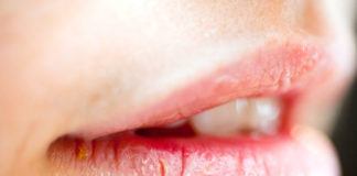 Home Remedies For Cracked Lips