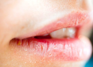 Home Remedies For Cracked Lips