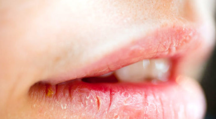 Home Remedies For Cracked Lips