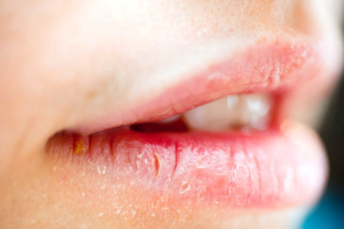 Home Remedies For Cracked Lips