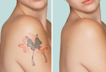 Remove Tattoo Naturally