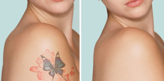 Remove Tattoo Naturally