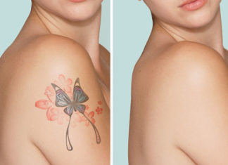 Remove Tattoo Naturally