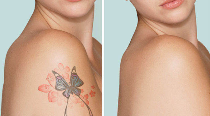 Remove Tattoo Naturally