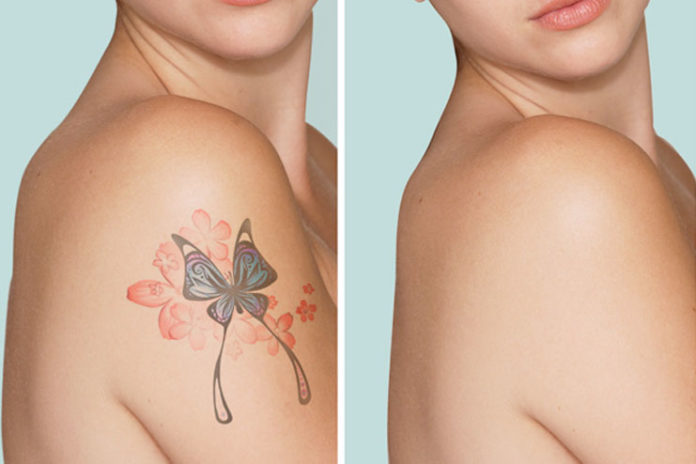 Remove Tattoo Naturally