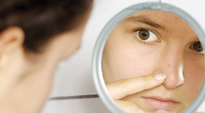 Baking Soda For Blackheads