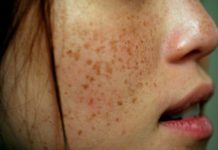 Treat Brown Spots