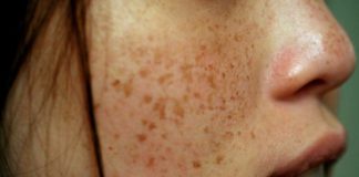 Treat Brown Spots